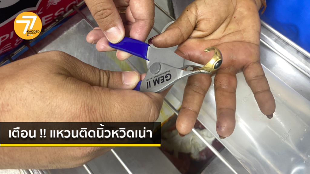 อุทาหรณ์ ใส่แหวนคับ นิ้วเน่าเนื้อตาย ต้องตัดนิ้ว